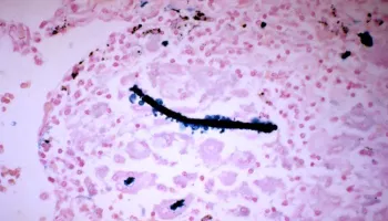 Size and Shape Matter: New Research Sheds Light on How Mesothelioma Develops