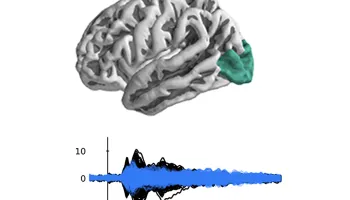 Emerging from The Fog: Little Understood Post-Stroke Cognitive Issues Verified