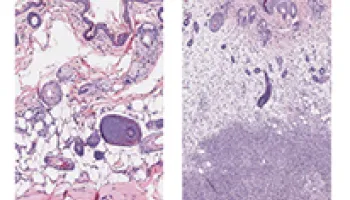 University of Maryland Researchers Identify Genes Linked to “Flesh-eating” Bacterial Infections